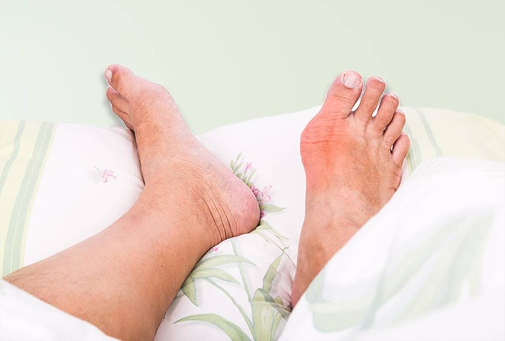 Chi Phí Mổ Gout: Tất Cả Những Điều Bạn Cần Biết