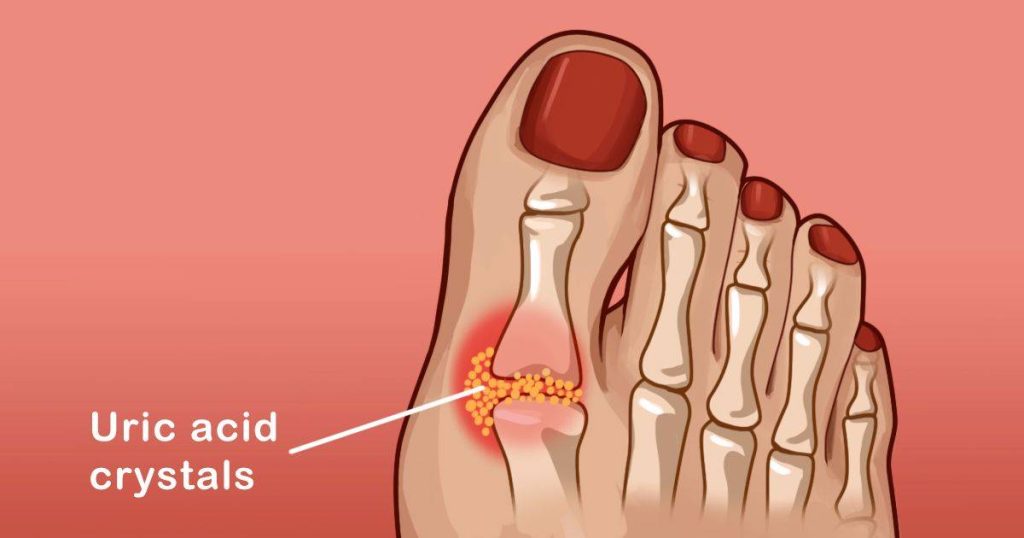 Chỉ Số Acid Uric Bao Nhiêu Thì Bị Gout? Cách Phòng Ngừa Hiệu Quả