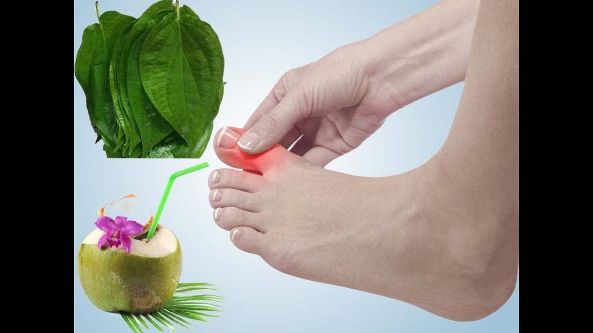 Chữa gút bằng nước dừa và lá trầu không