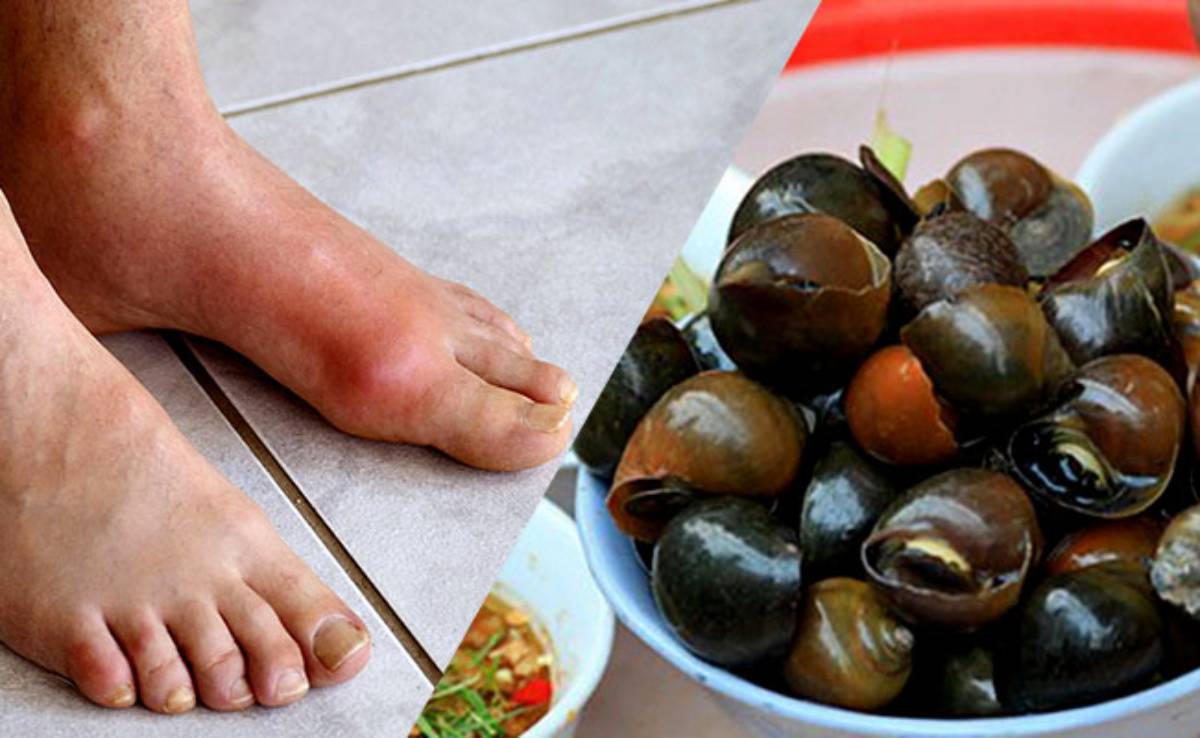 Những lưu ý khi người bị gout ăn ốc