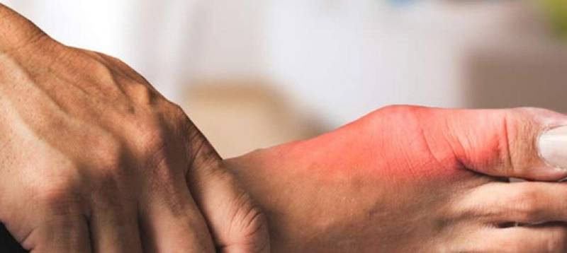 Triệu chứng bệnh gout không phải lúc nào cũng rõ ràng